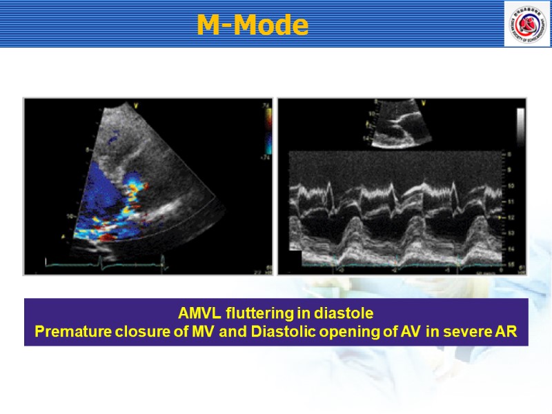 M-Mode  AMVL fluttering in diastole Premature closure of MV and Diastolic opening of